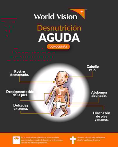 Desnutrición Aguda