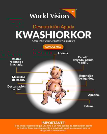 Desnutrición Kwashiorkor